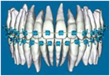 Braces on Orthodontic 3-D Digital Model of Teeth